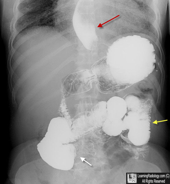 Gastrointestinal Scleroderma